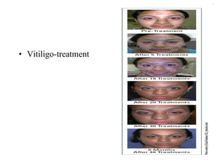 Vitiligo-treatment 