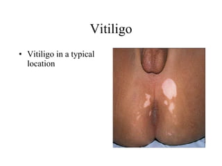 Vitiligo Vitiligo in a typical location  