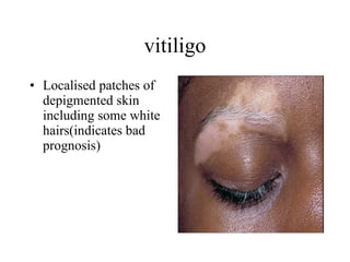 vitiligo Localised patches of depigmented skin including some white hairs(indicates bad prognosis) 