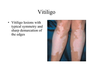 Vitiligo Vitiligo lesions with typical symmetry and sharp demarcation of the edges  