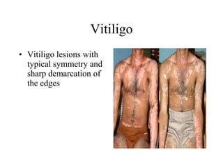 Vitiligo Vitiligo lesions with typical symmetry and sharp demarcation of the edges  