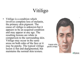 Vitiligo Vitiligo is a condition which involves complete loss of melanin, the primary skin pigment. The cause of vitiligo is unknown but it appears to be an acquired condition and may appear at any age. The resulting lesions are white in comparison to the surrounding skin. Vitiligo may occur in the same areas on both sides of the face or it may be patchy. The typical vitiligo lesion is flat and depigmented, but maintains the normal skin texture. 