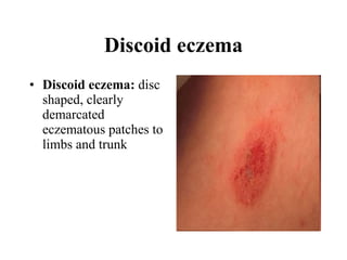 Discoid eczema Discoid eczema:  disc shaped, clearly demarcated eczematous patches to limbs and trunk  