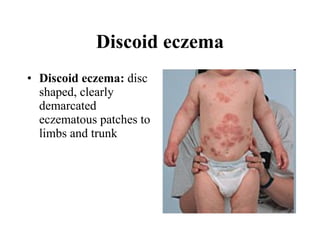 Discoid eczema Discoid eczema:  disc shaped, clearly demarcated eczematous patches to limbs and trunk  