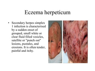 Eczema herpeticum Secondary herpes simplex 1 infection is characterised by a sudden onset of grouped, small white or clear fluid filled vesicles, satellite or "punch out" lesions, pustules, and erosions. It is often tender, painful and itchy.  