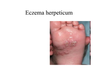 Eczema herpeticum 
