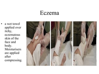 Eczema a wet towel applied over itchy, eczematous skin of the face and body. Moisturisers are applied after compressing.  