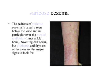 varicose  eczema The redness of  varicose  eczema is usually seen below the knee and in particular over the  medial   malleolus  (inner ankle bone). Swelling can occur, but  erythema  and dryness of the skin are the major signs to look for.  