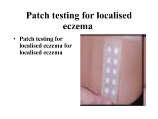 Patch testing for localised eczema   Patch testing for localised eczema for localised eczema   