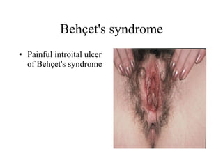 Behçet's syndrome Painful introital ulcer of Behçet's syndrome  