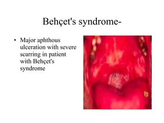 Behçet's syndrome- Major aphthous ulceration with severe scarring in patient with Behçet's syndrome  