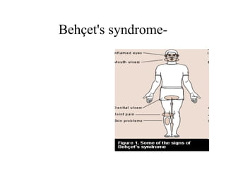 Behçet's syndrome- 