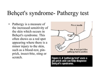 Behçet's syndrome- Pathergy test Pathergy is a measure of the increased sensitivity of the skin which occurs in Behçet's syndrome. This often shows as a red spot appearing where there is a minor injury to the skin, such as a blood-test, pin-prick, insect-bite, sting or scratch.  