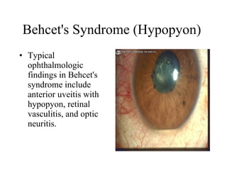Behcet's Syndrome (Hypopyon)  Typical ophthalmologic findings in Behcet's syndrome include anterior uveitis with hypopyon, retinal vasculitis, and optic neuritis.  