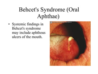 Behcet's Syndrome (Oral Aphthae)  Systemic findings in Behcet's syndrome may include aphthous ulcers of the mouth. 