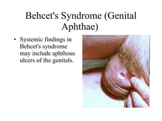 Behcet's Syndrome (Genital Aphthae)  Systemic findings in Behcet's syndrome may include aphthous ulcers of the genitals.  