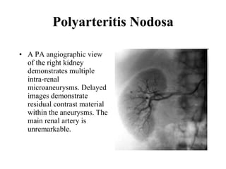 Polyarteritis Nodosa A PA angiographic view of the right kidney demonstrates multiple intra-renal microaneurysms. Delayed images demonstrate residual contrast material within the aneurysms. The main renal artery is unremarkable.  