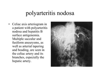 polyarteritis nodosa Celiac axis arteriogram in a patient with polyarteritis nodosa and hepatitis B surface antigenemia. Multiple saccular and fusiform aneurysms, as well as arterial tapering and beading, are seen in the celiac artery and its branches, especially the hepatic artery.  
