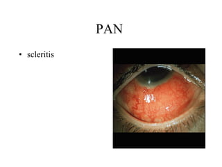 PAN  scleritis 