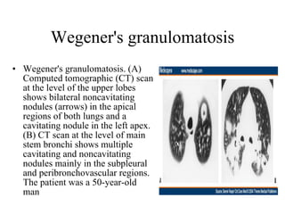 Wegener's granulomatosis Wegener's granulomatosis. (A) Computed tomographic (CT) scan at the level of the upper lobes shows bilateral noncavitating nodules (arrows) in the apical regions of both lungs and a cavitating nodule in the left apex. (B) CT scan at the level of main stem bronchi shows multiple cavitating and noncavitating nodules mainly in the subpleural and peribronchovascular regions. The patient was a 50-year-old man  