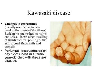 Kawasaki disease  Changes in extremities  (usually occurs one to two weeks after onset of the illness) :  Reddening and rashes on palms and soles. Unexplained swelling of hands and feet peeling of the skin around fingernails and toenails  Periungual desquamation on day 12 of illness in a three-year-old child with Kawasaki disease.   