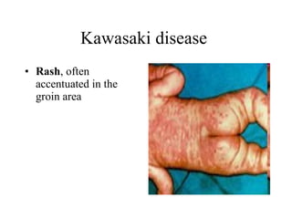 Kawasaki disease  Rash , often accentuated in the groin area  