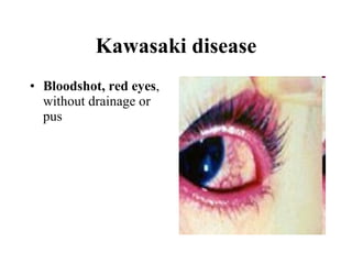 Kawasaki disease Bloodshot, red eyes , without drainage or pus  