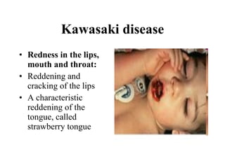 Kawasaki disease Redness in the lips, mouth and throat:   Reddening and cracking of the lips  A characteristic reddening of the tongue, called strawberry tongue  
