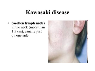 Kawasaki disease Swollen lymph nodes  in the neck (more than 1.5 cm), usually just on one side  