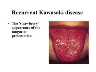 Recurrent Kawasaki disease   The 'strawberry' appearance of the tongue at presentation   