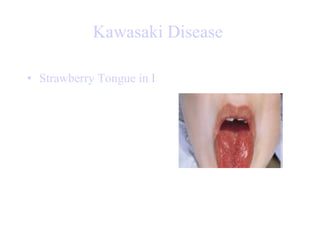 Kawasaki Disease   Strawberry Tongue in Kawasaki Disease   