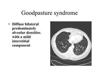 Goodpasture syndrome Diffuse bilateral predominately alveolar densities with a mild interstitial component  