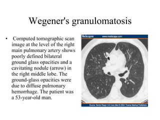 Wegener's granulomatosis Computed tomographic scan image at the level of the right main pulmonary artery shows poorly defined bilateral ground glass opacities and a cavitating nodule (arrow) in the right middle lobe. The ground-glass opacities were due to diffuse pulmonary hemorrhage. The patient was a 53-year-old man.  