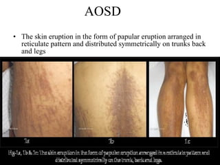 AOSD The skin eruption in the form of papular eruption arranged in reticulate pattern and distributed symmetrically on trunks back and legs 