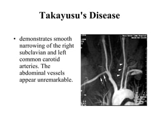 Takayusu's Disease demonstrates smooth narrowing of the right subclavian and left common carotid arteries. The abdominal vessels appear unremarkable.  