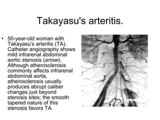 Takayasu's arteritis. 50-year-old woman with Takayasu's arteritis (TA). Catheter angiography shows mild infrarenal abdominal aortic stenosis ( arrow ). Although atherosclerosis commonly affects infrarenal abdominal aorta, atherosclerosis usually produces abrupt caliber changes just beyond stenosis sites; the smooth tapered nature of this stenosis favors TA.   