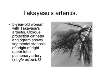 Takayasu's arteritis. 5-year-old woman with Takayasu's arteritis. Oblique projection catheter angiogram shows segmental stenosis of origin of right upper lobe pulmonary artery ( single arrow ). O   