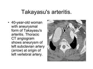 Takayasu's arteritis. 40-year-old woman with aneurysmal form of Takayasu's arteritis. Thoracic CT angiogram shows aneurysm of left subclavian artery ( arrow ) at origin of left vertebral artery.   