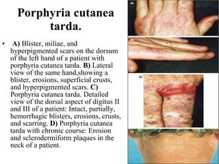 Porphyria cutanea tarda.   A)  Blister, miliae, and hyperpigmented scars on the dorsum of the left hand of a patient with porphyria cutanea tarda.  B)  Lateral view of the same hand,showing a blister, erosions, superficial crusts, and hyperpigmented scars.  C)  Porphyria cutanea tarda. Detailed view of the dorsal aspect of digitus II and III of a patient: Intact, partially, hemorrhagic blisters, erosions, crusts, and scarring.  D)  Porphyria cutanea tarda with chronic course: Erosion and sclerodermiform plaques in the neck of a patient.  