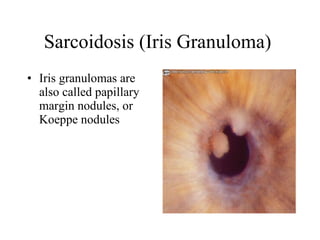 Sarcoidosis (Iris Granuloma)  Iris granulomas are also called papillary margin nodules, or Koeppe nodules  