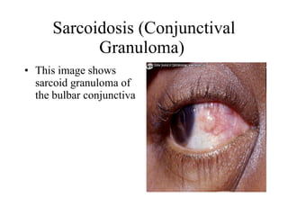 Sarcoidosis (Conjunctival Granuloma)  This image shows sarcoid granuloma of the bulbar conjunctiva  
