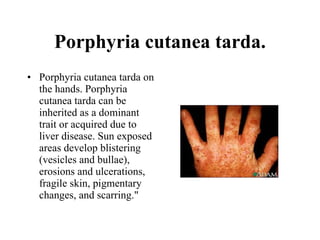 Porphyria cutanea tarda. Porphyria cutanea tarda on the hands. Porphyria cutanea tarda can be inherited as a dominant trait or acquired due to liver disease. Sun exposed areas develop blistering (vesicles and bullae), erosions and ulcerations, fragile skin, pigmentary changes, and scarring."  