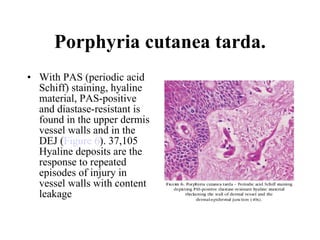 Porphyria cutanea tarda. With PAS (periodic acid Schiff) staining, hyaline material, PAS-positive and diastase-resistant is found in the upper dermis vessel walls and in the DEJ ( Figure 6 ). 37,105 Hyaline deposits are the response to repeated episodes of injury in vessel walls with content leakage  