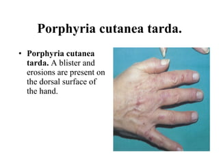 Porphyria cutanea tarda. Porphyria cutanea tarda.  A blister and erosions are present on the dorsal surface of the hand. 