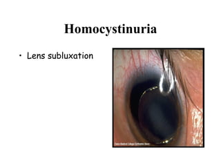 Homocystinuria Lens subluxation   