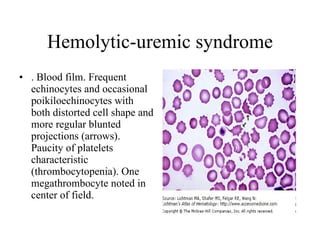 Hemolytic-uremic syndrome . Blood film. Frequent echinocytes and occasional poikiloechinocytes with both distorted cell shape and more regular blunted projections (arrows). Paucity of platelets characteristic (thrombocytopenia). One megathrombocyte noted in center of field.  
