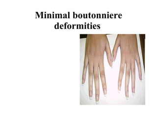 Minimal boutonniere deformities   