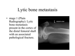 Lytic bone metastasis mage 1 (Plain Radiography): Lytic bone metastasis present in the cortex of the distal femoral shaft with an associated pathological fracture.  