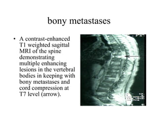 bony metastases A contrast-enhanced T1 weighted sagittal MRI of the spine demonstrating multiple enhancing lesions in the vertebral bodies in keeping with bony metastases and cord compression at T7 level (arrow).  