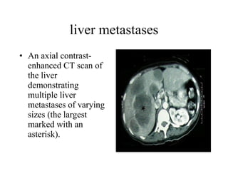 liver metastases An axial contrast-enhanced CT scan of the liver demonstrating multiple liver metastases of varying sizes (the largest marked with an asterisk).  